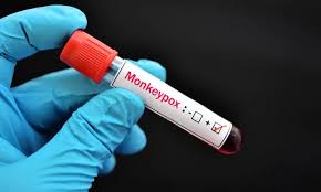 New Monkeypox Case Reported in Karachi, Wife Infected After Husband